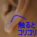 耳たぶケロイド